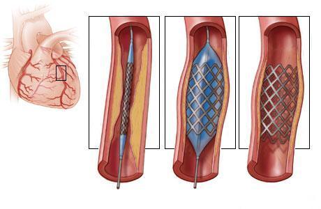 Методика баллонной ангиопластики и стентирования коронарных артерий