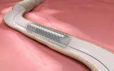 Баллонная ангиопластика и стентирование коронарных артерий